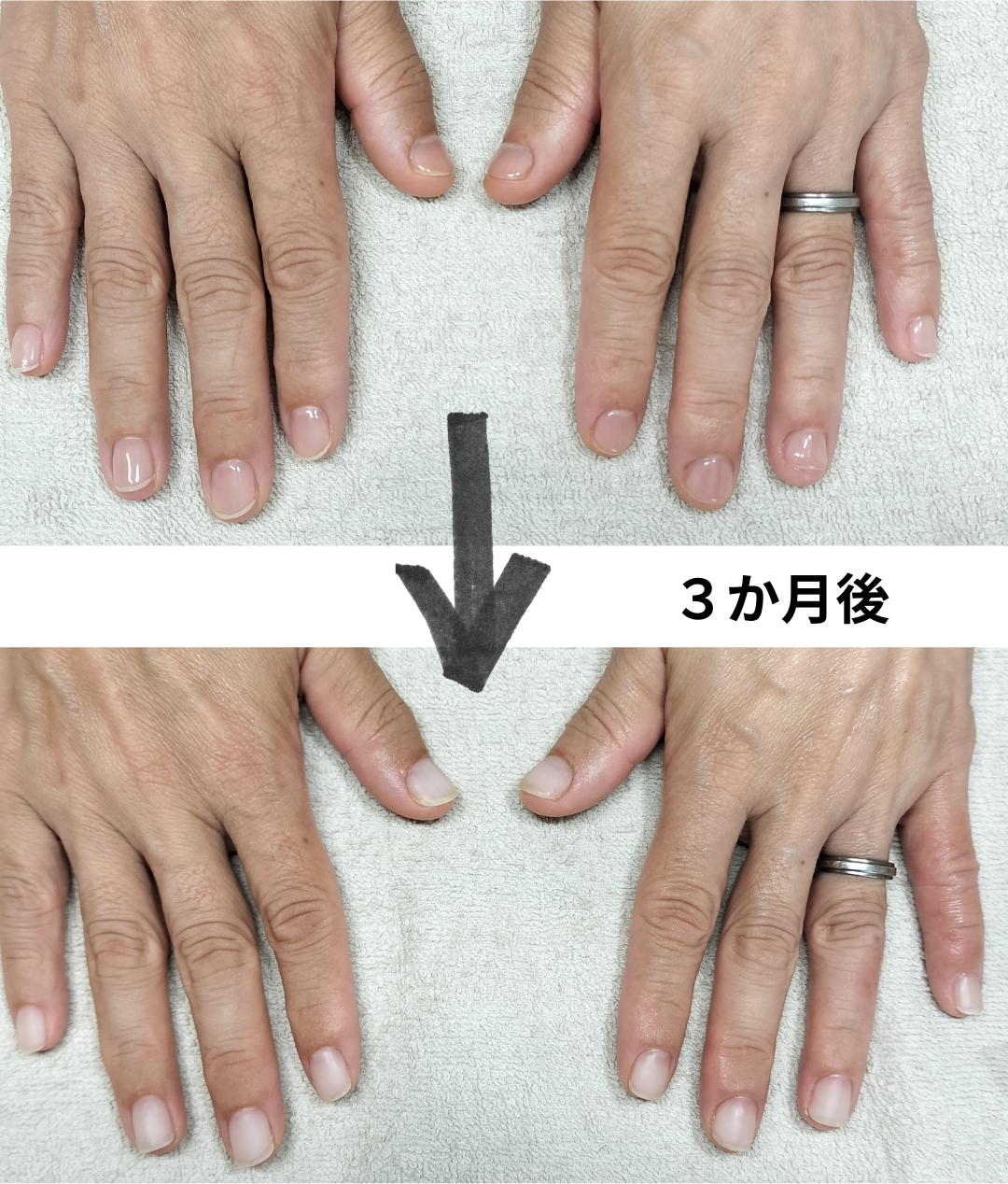 ひたちなか市 リプロネイル式深爪/巻き爪矯正専門店ネイルサロン スピカ事例写真