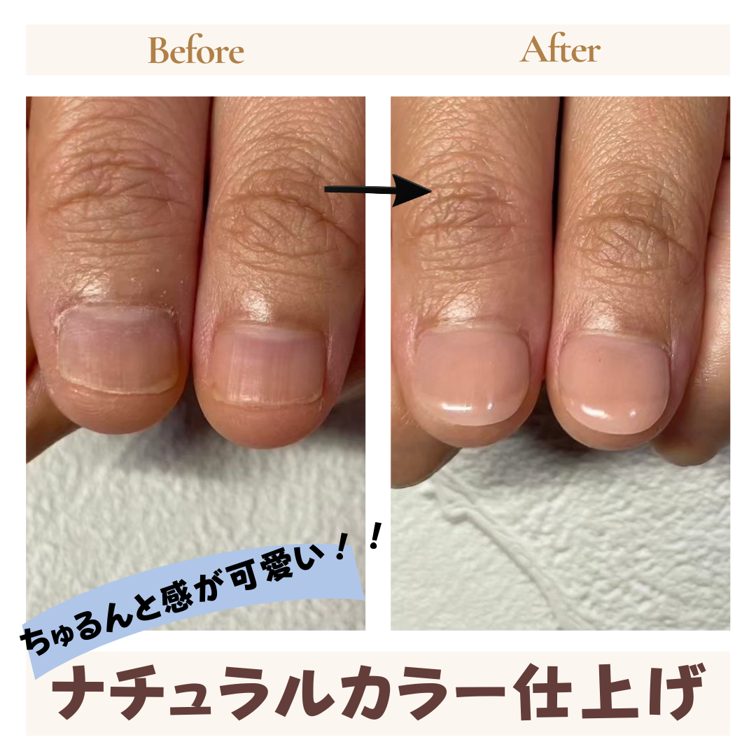 ネイルサロンブルーム リプロネイル式深爪矯正事例写真