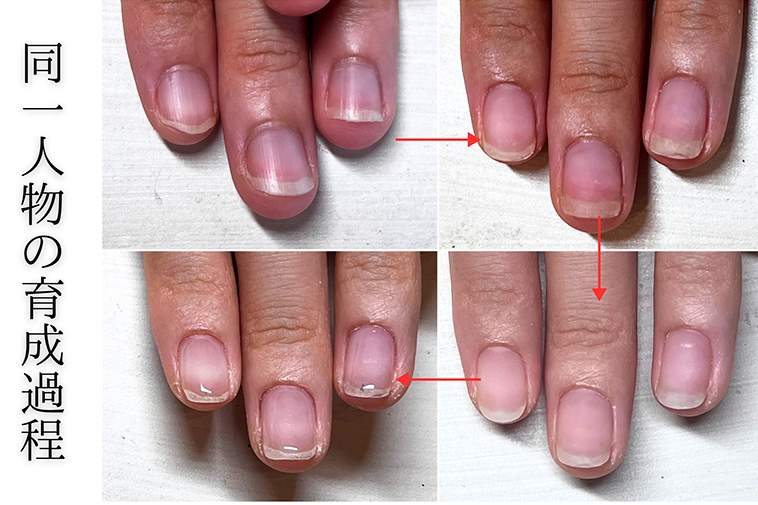 広島市リプロネイル式深爪矯正 ネイルサロンヴェールリム