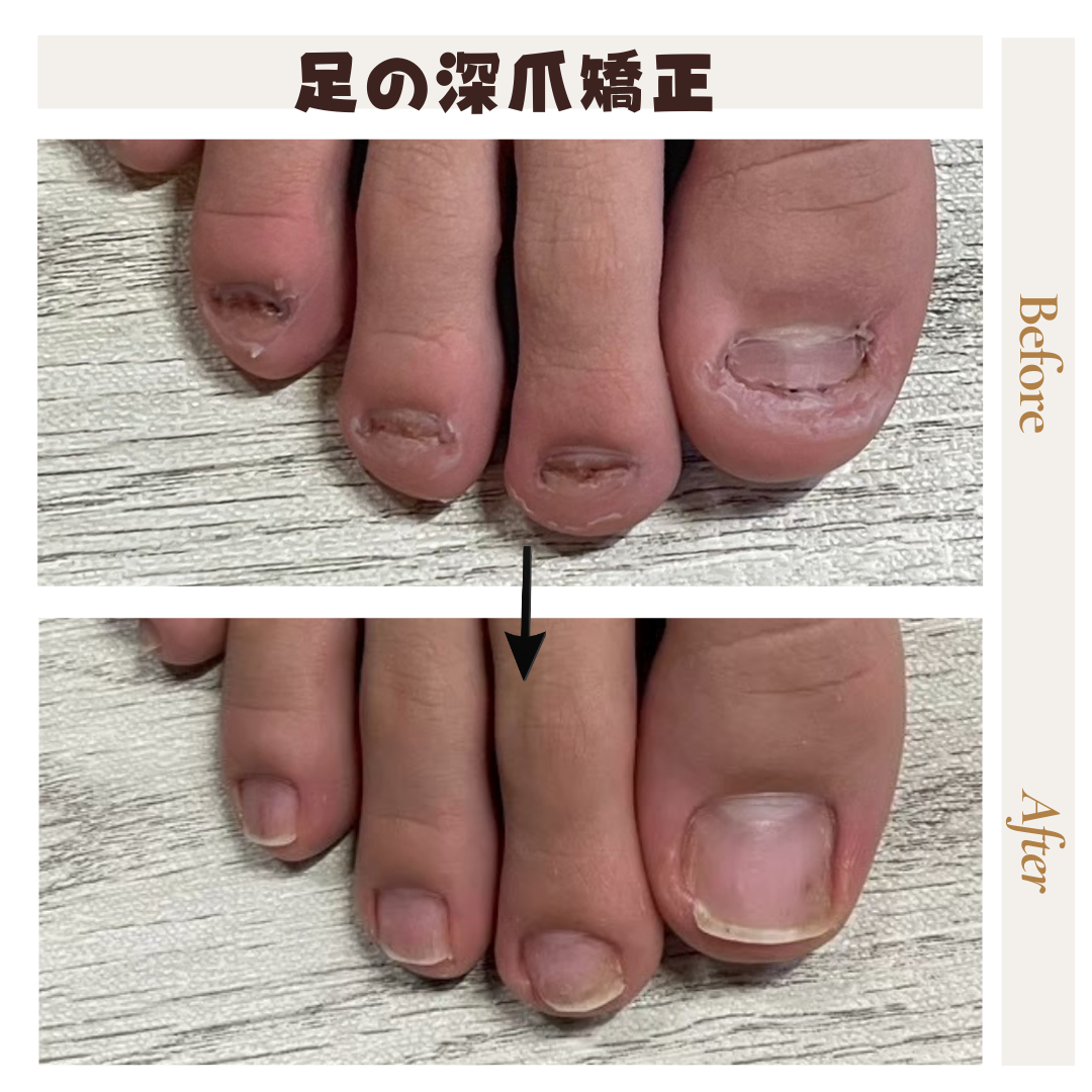 ネイルサロンブルーム リプロネイル式深爪矯正事例写真
