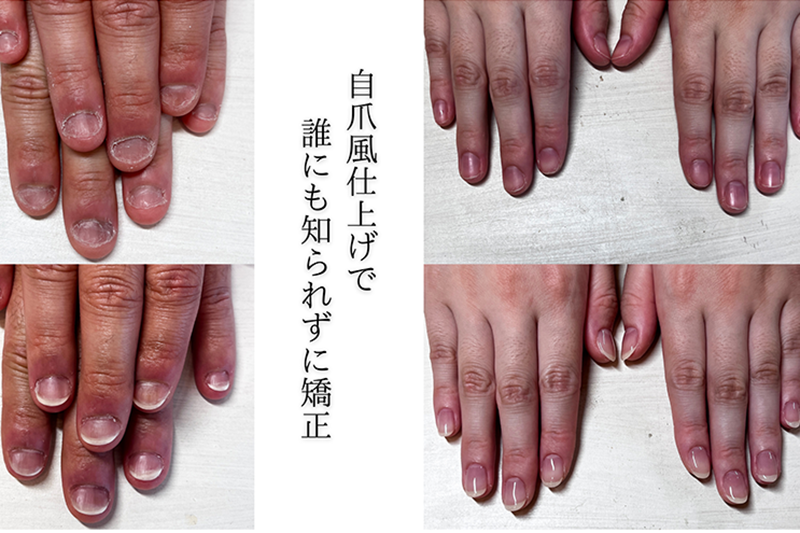 広島市リプロネイル式深爪矯正 ネイルサロンヴェールリム