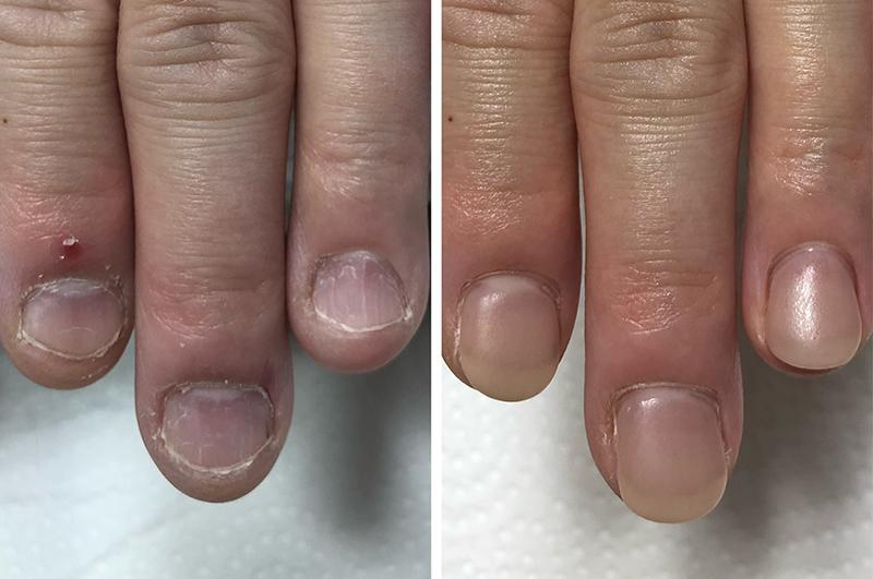 八王子深爪矯正専門ネイルサロンエルナ