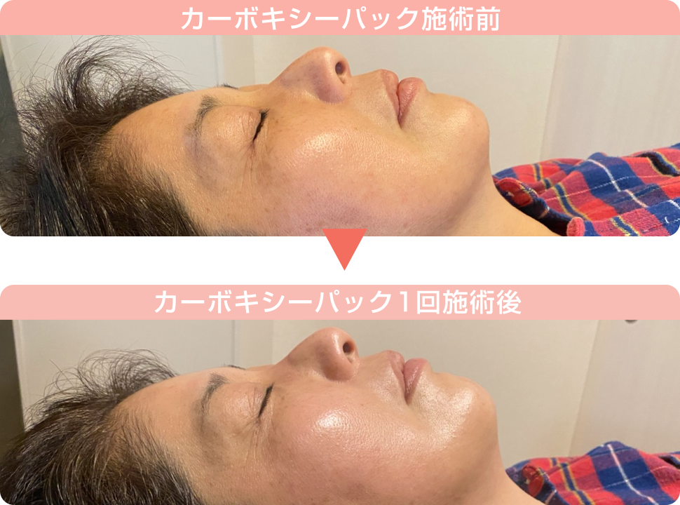 カーボキシー炭酸パック施術後