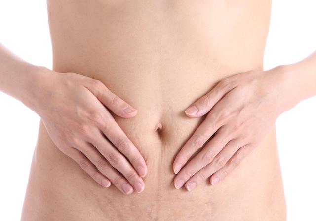 stretch marks due to pregnancy