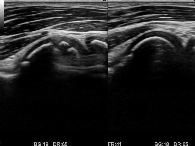 離断性骨軟骨炎