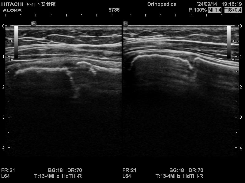 リトルリーグ肩