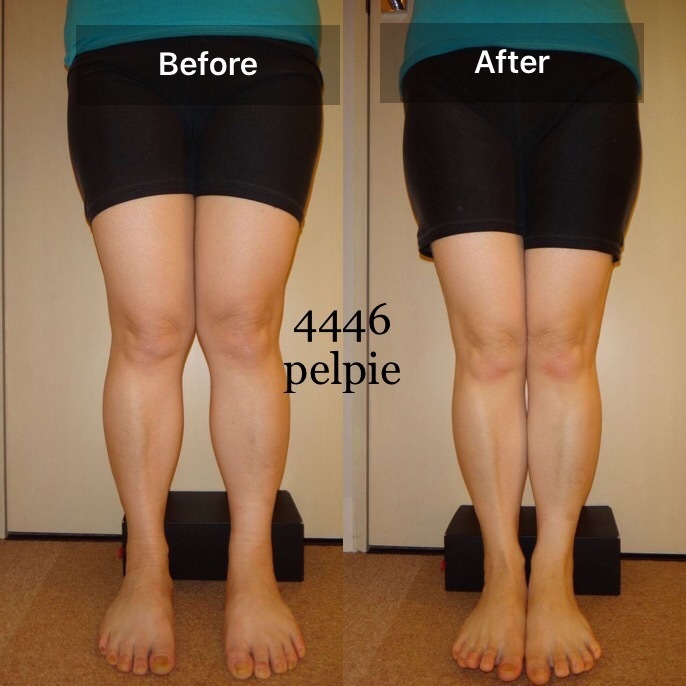 岡山 O脚矯正 ペルピエ