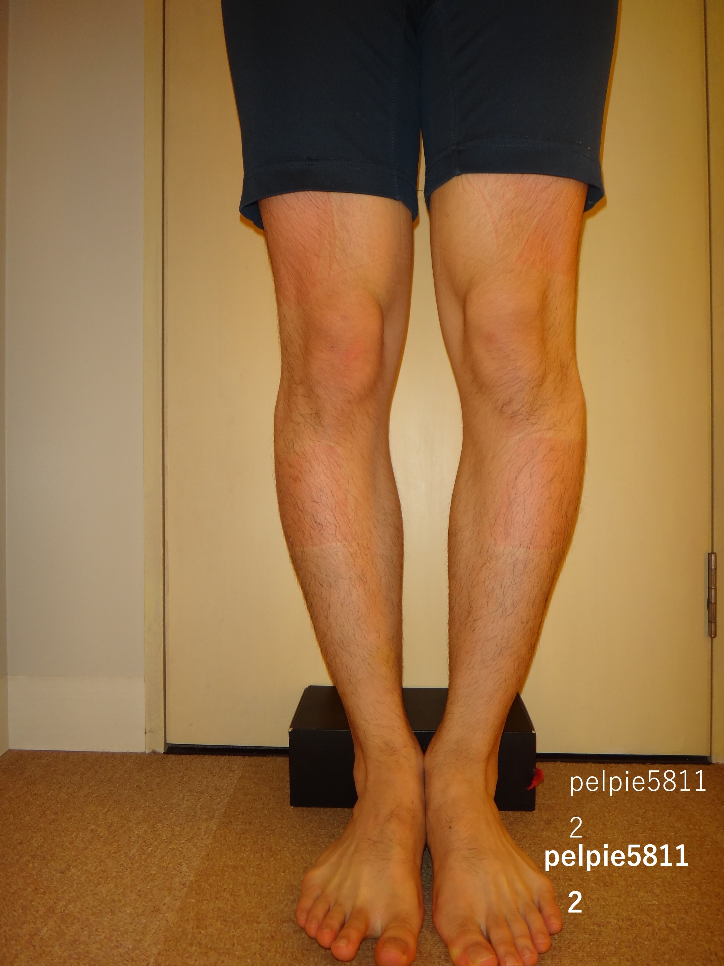 岡山 O脚矯正 ペルピエ