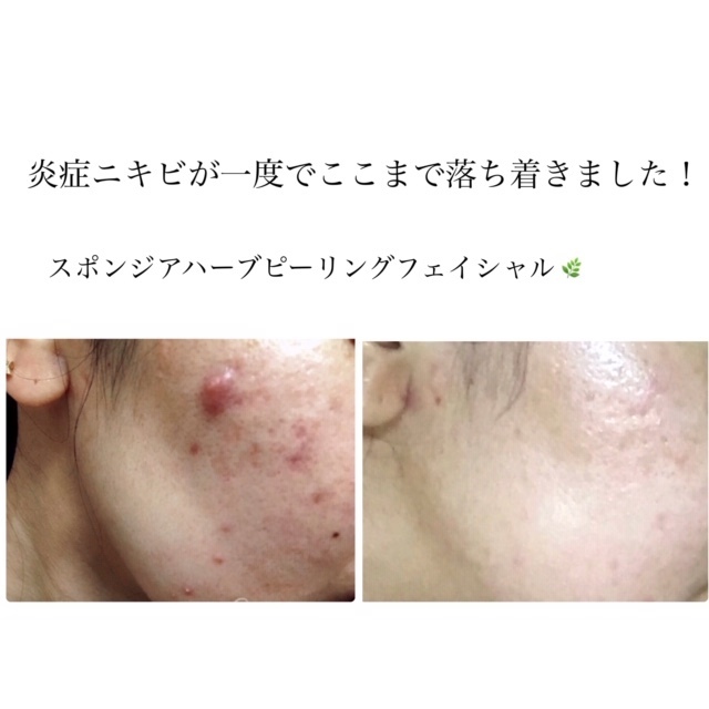 奈良のニキビ ニキビ跡ケアならホリスティックサロンヘルバ