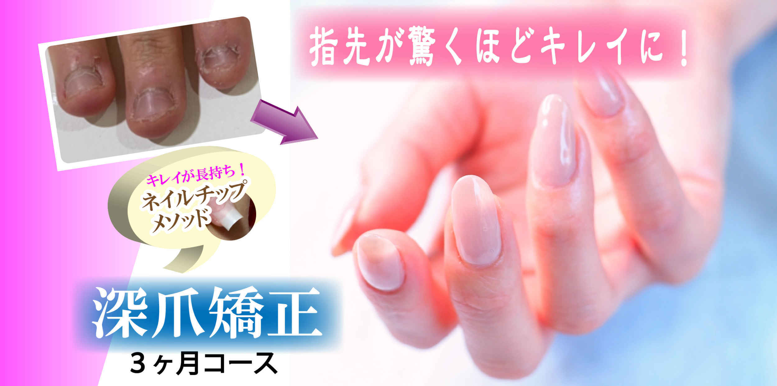 爪をキレイにするネイルサロン 深爪矯正が得意なネイルサロン ティアリーネイル