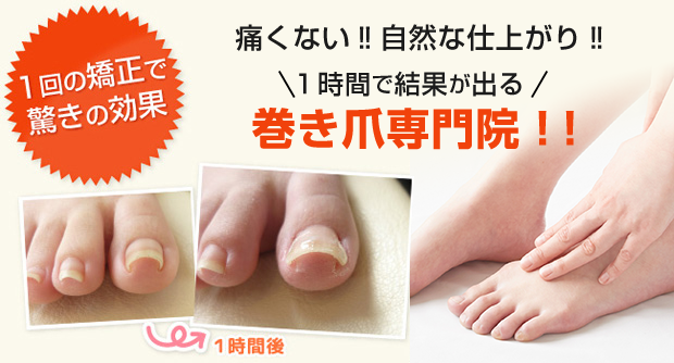 愛媛松山の三番町に在る 巻き爪専門院 えひめ巻き爪サロン 松山店 は あなたの爪の110番