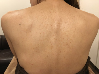 金沢 野々市でニキビ撃退 ハーブピーリングcocotii