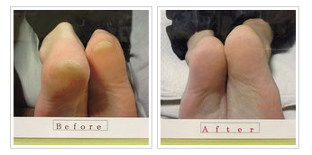 左：中敷き使用前 右：使用後(3か月) かかとの角質・位置の改善