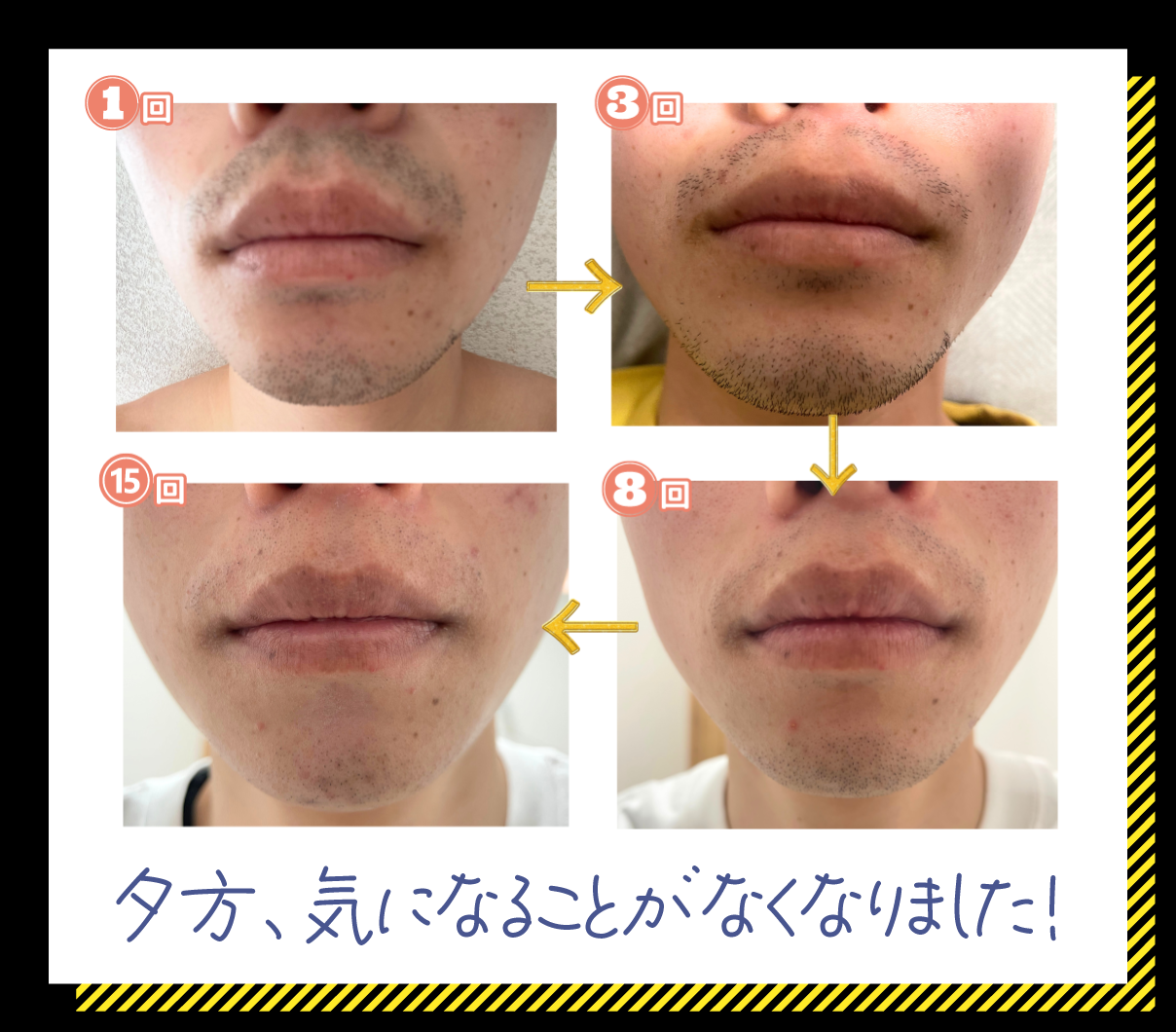 20代男性 髭脱毛例