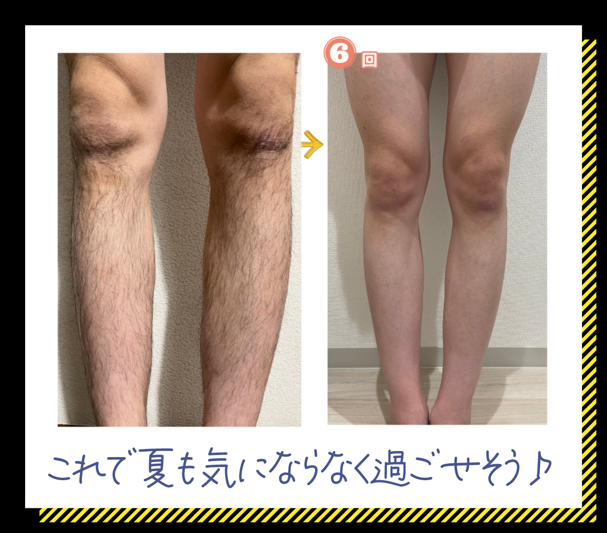 20代男性 足の脱毛例