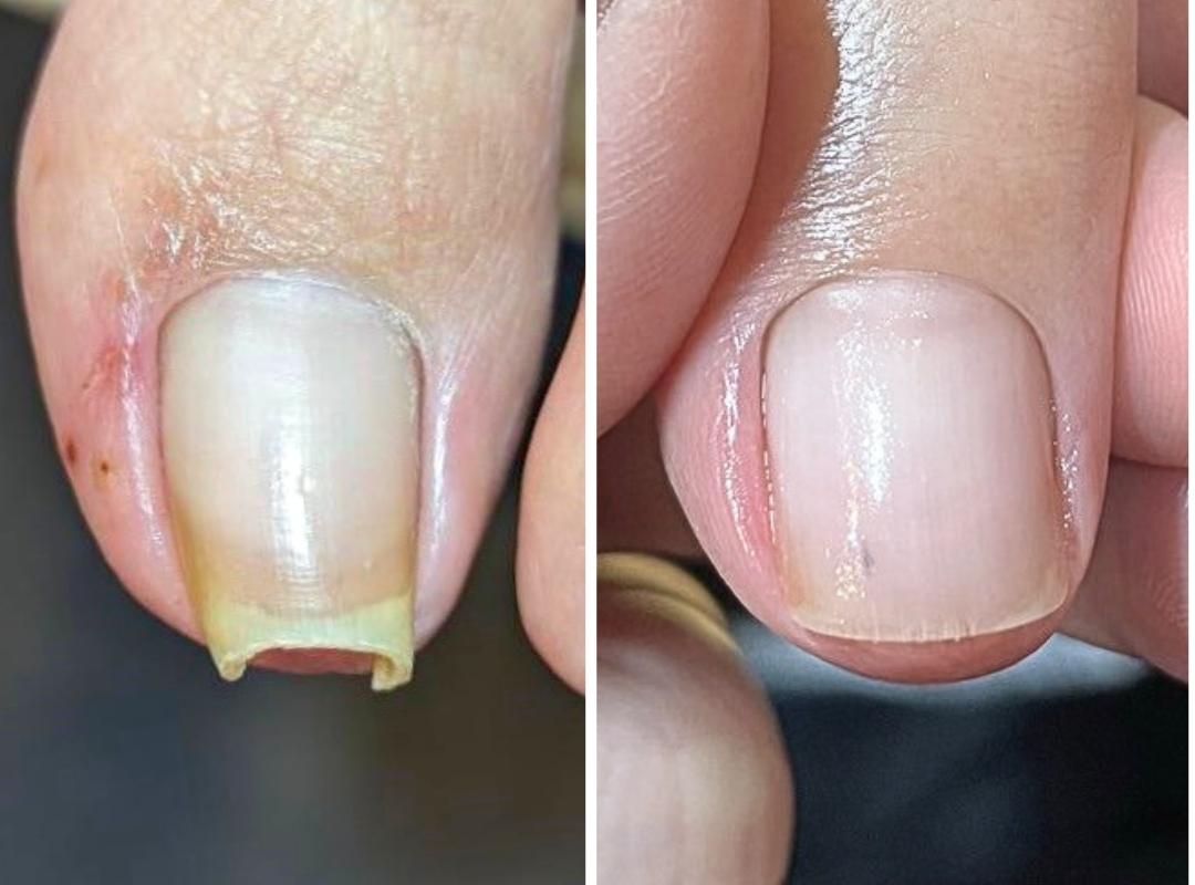 新浦安駅徒歩6分_手足のトラブル専門サロンaccorto_巻き爪の症例