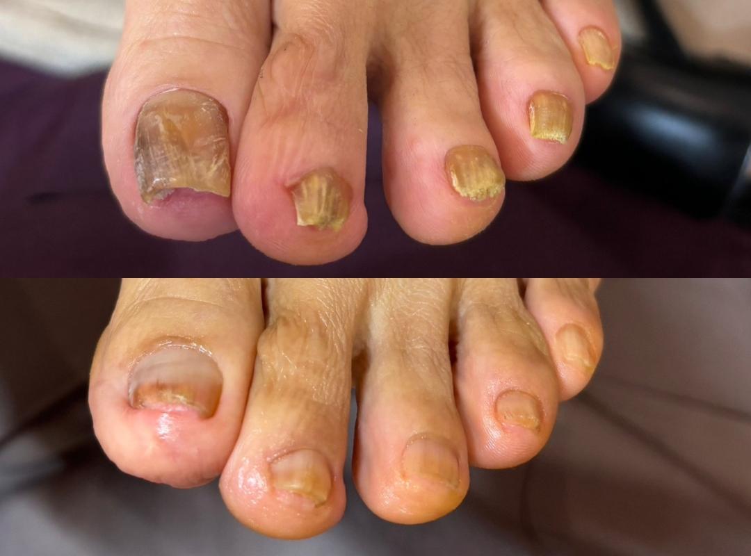 新浦安駅徒歩6分_手足のトラブル専門サロンaccorto_変形爪・肥厚・変色・白癬菌の症例