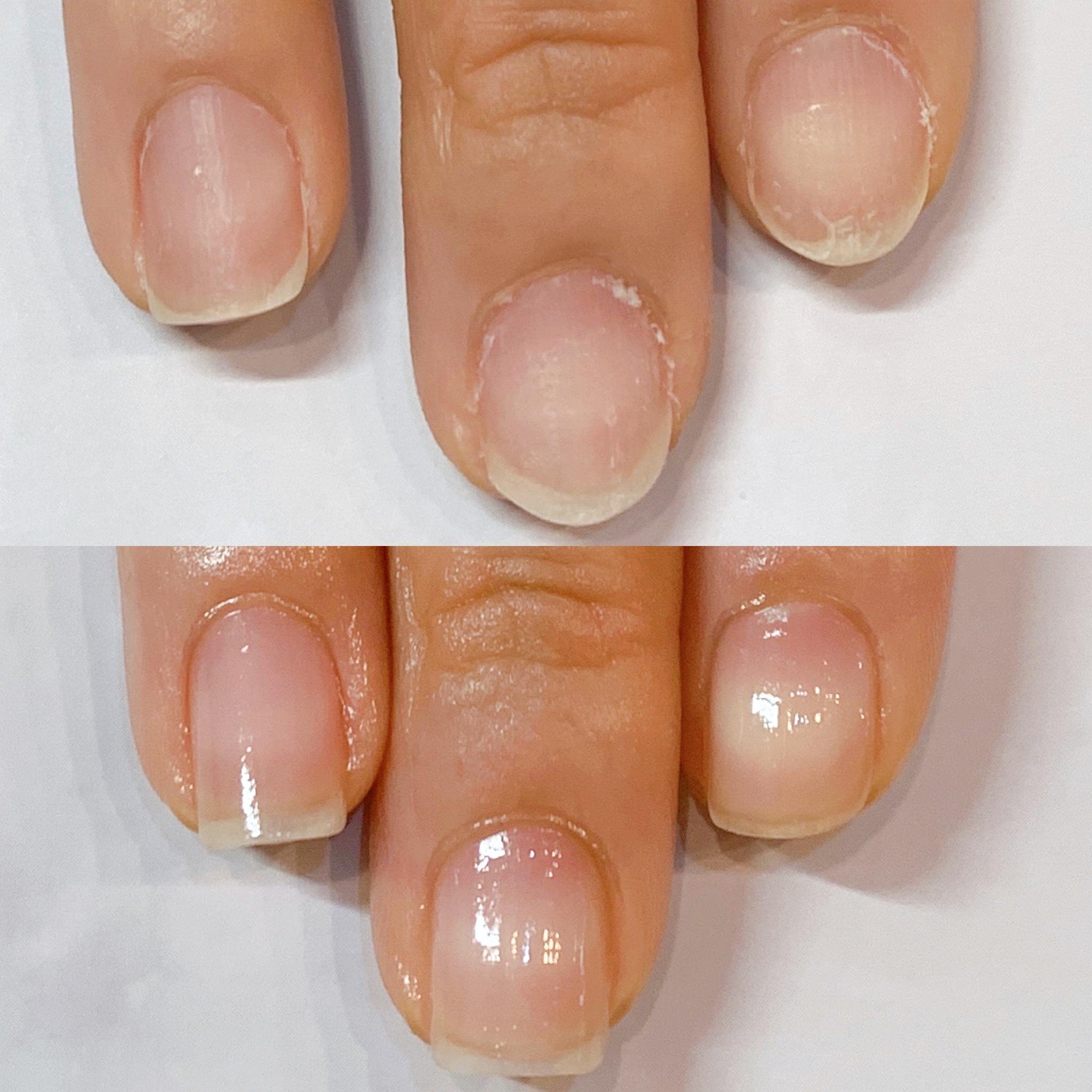 手の爪・育成ケアの症例写真