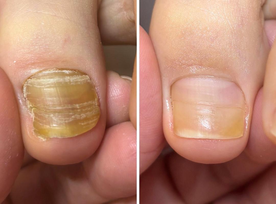 新浦安駅徒歩6分_手足のトラブル専門サロンaccorto_爪甲湾症の症例