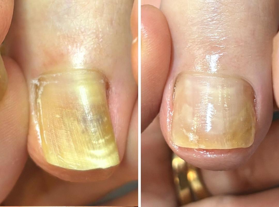 新浦安駅徒歩6分_手足のトラブル専門サロンaccorto_変形爪の症例