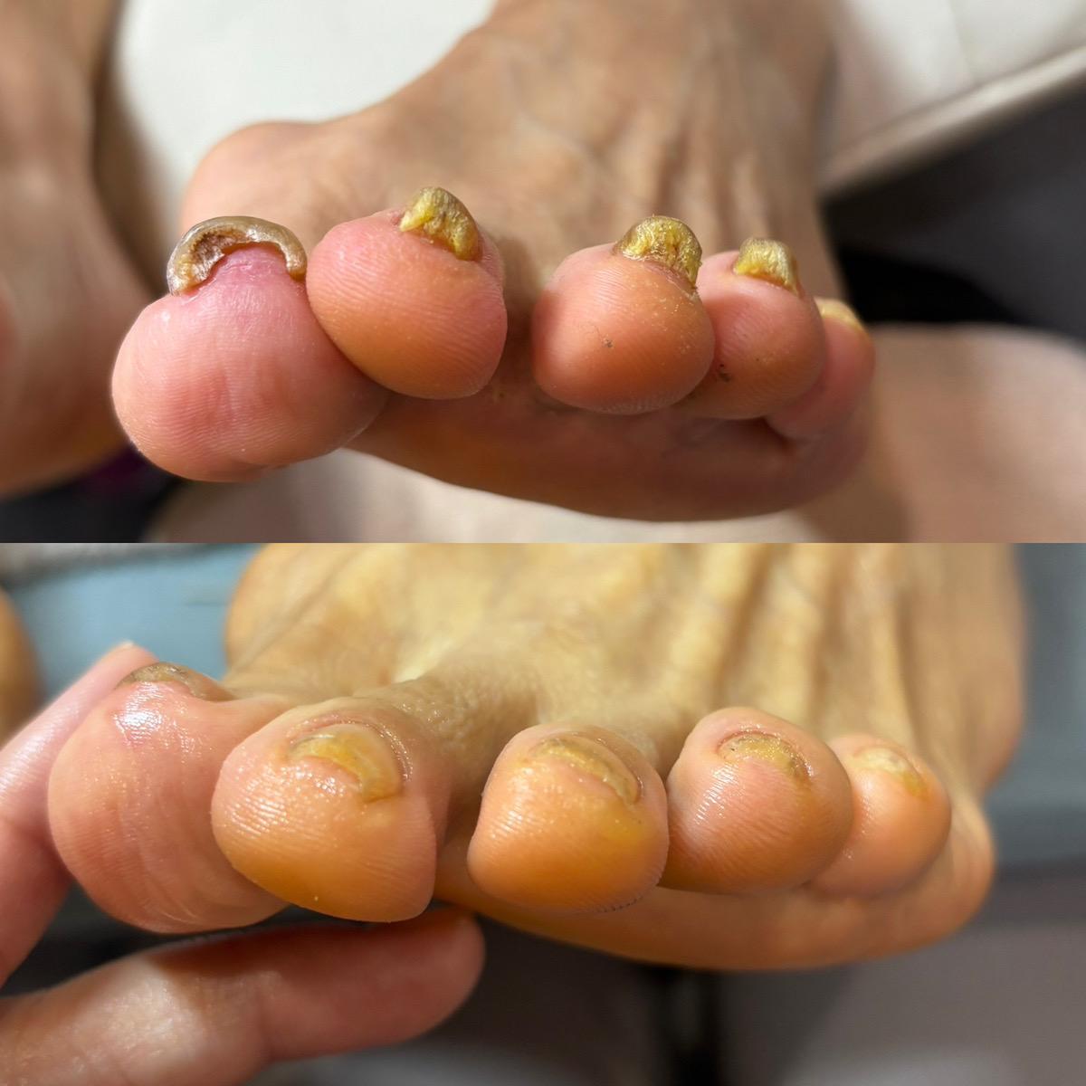 変形爪・肥厚・変色・白癬菌の症例写真