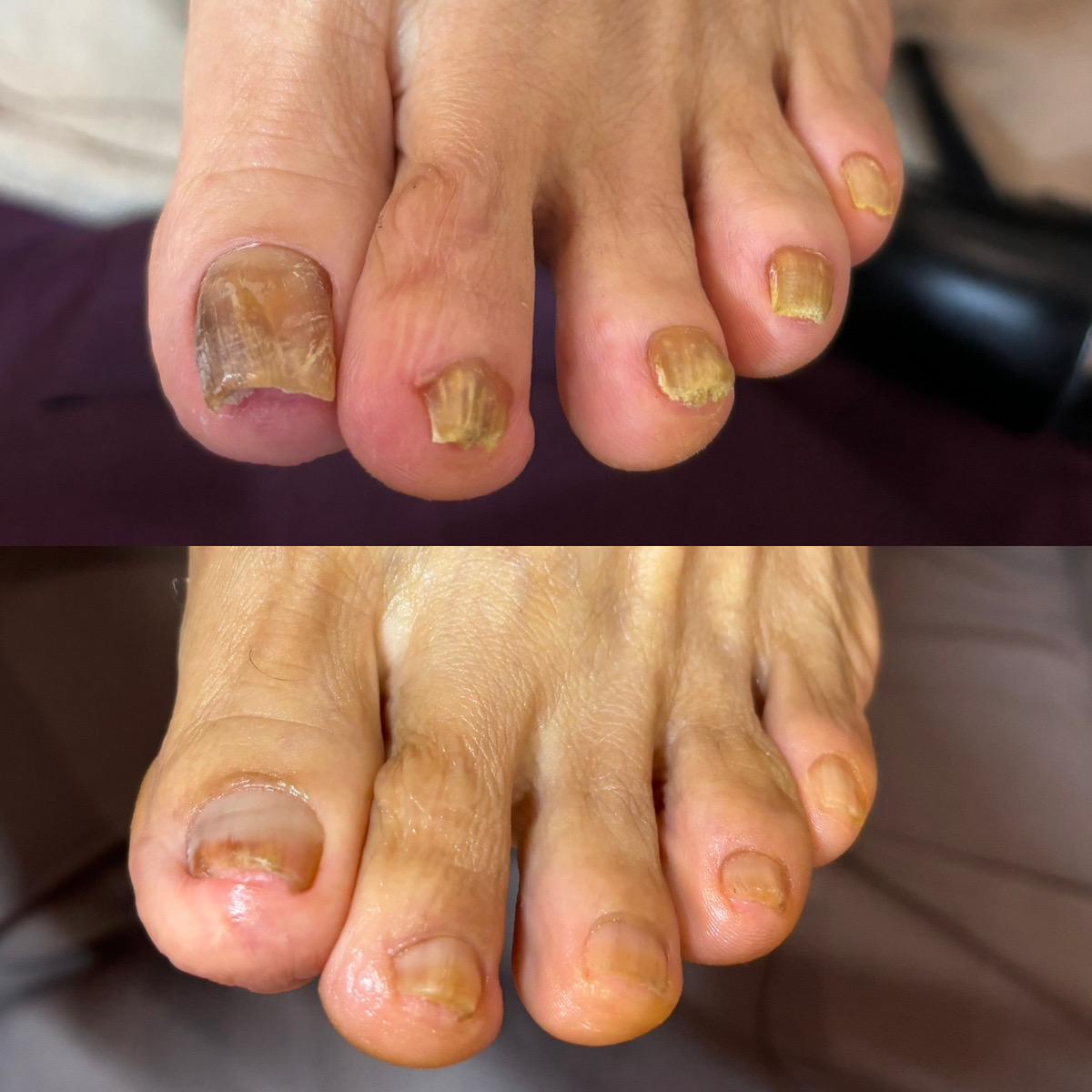 変形爪・肥厚・変色・白癬菌の症例写真