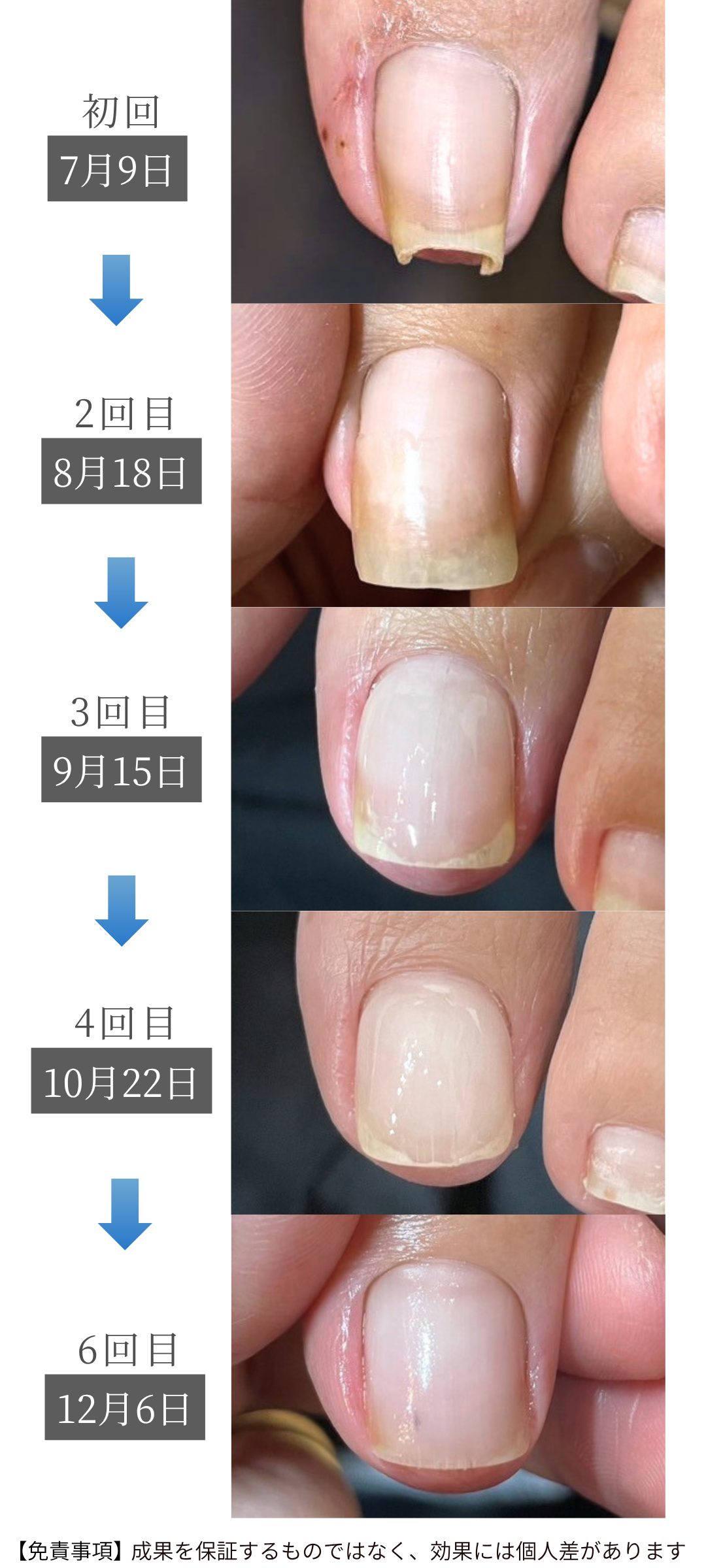 巻き爪の育成過程症例