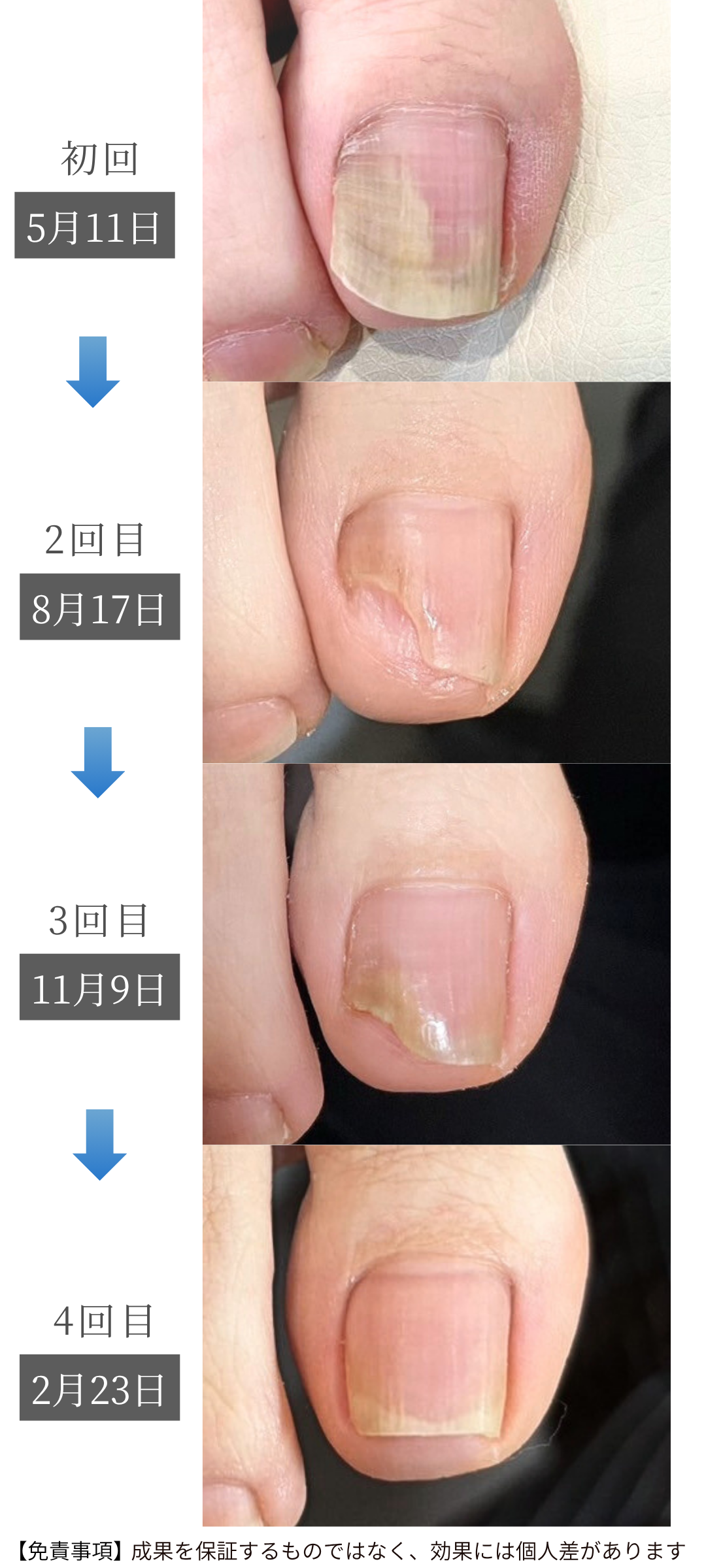 剥離の育成過程症例
