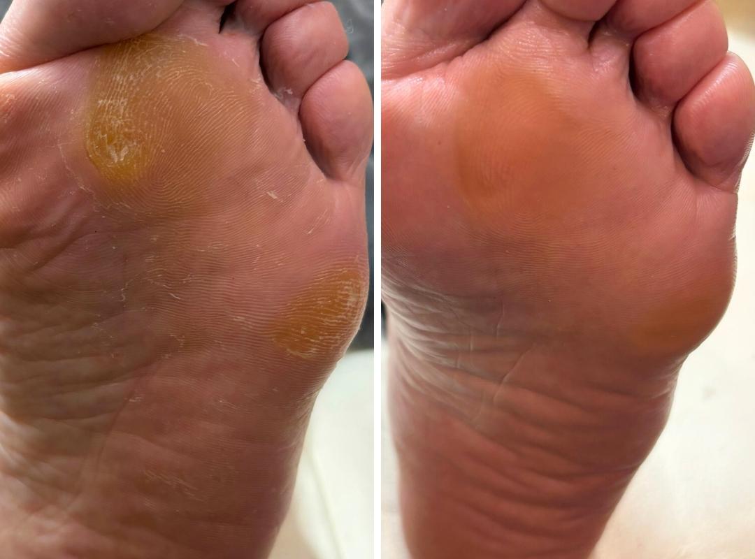 タコ・魚の目の症例写真