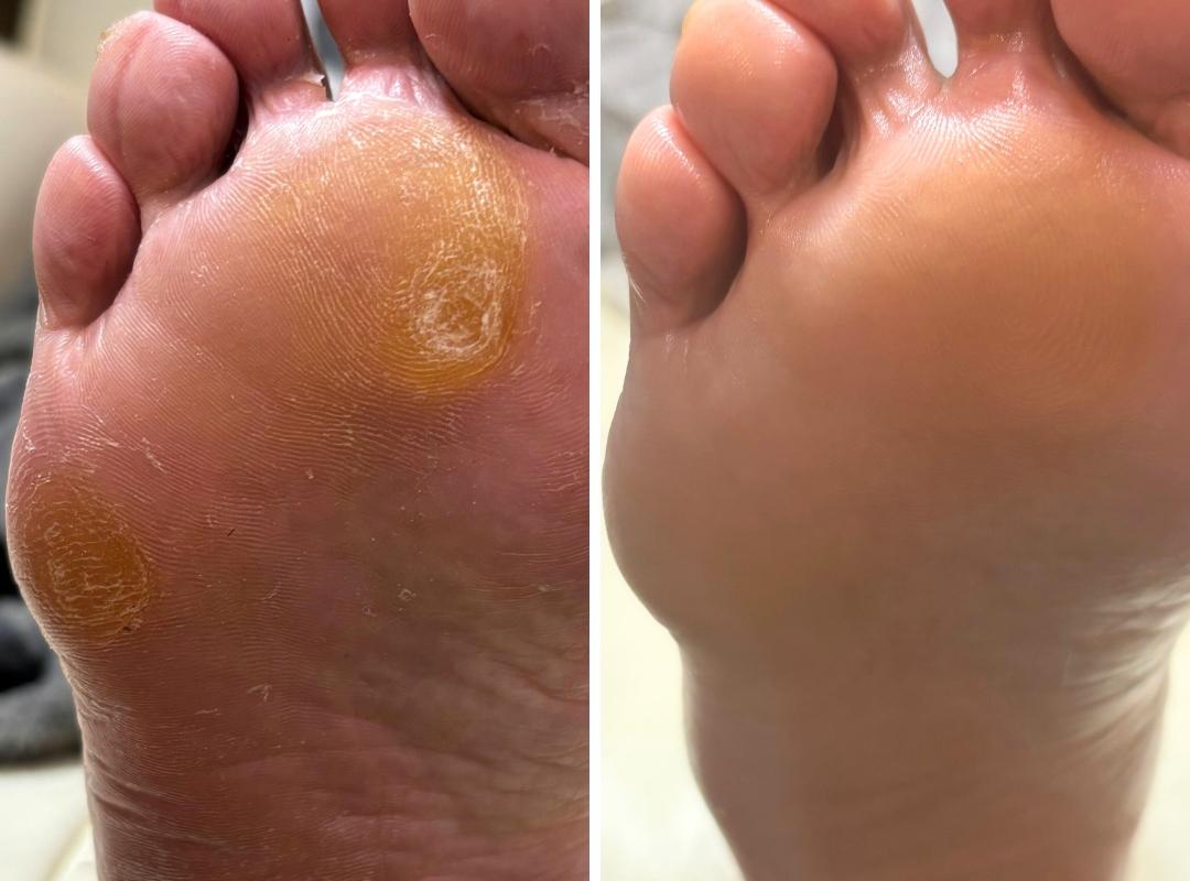 タコ・魚の目・角質ケアの症例写真