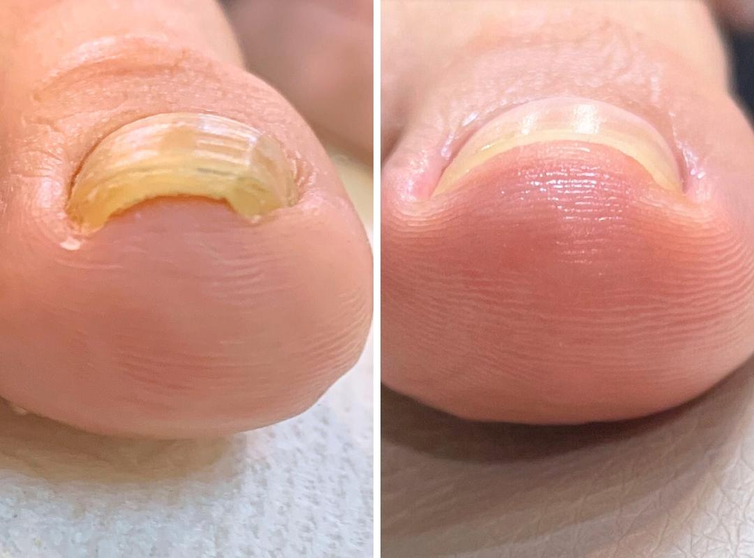 変形爪・肥厚・段差の症例写真