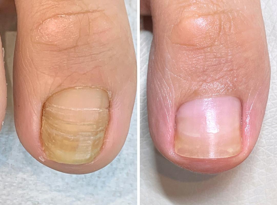 変形爪の症例写真