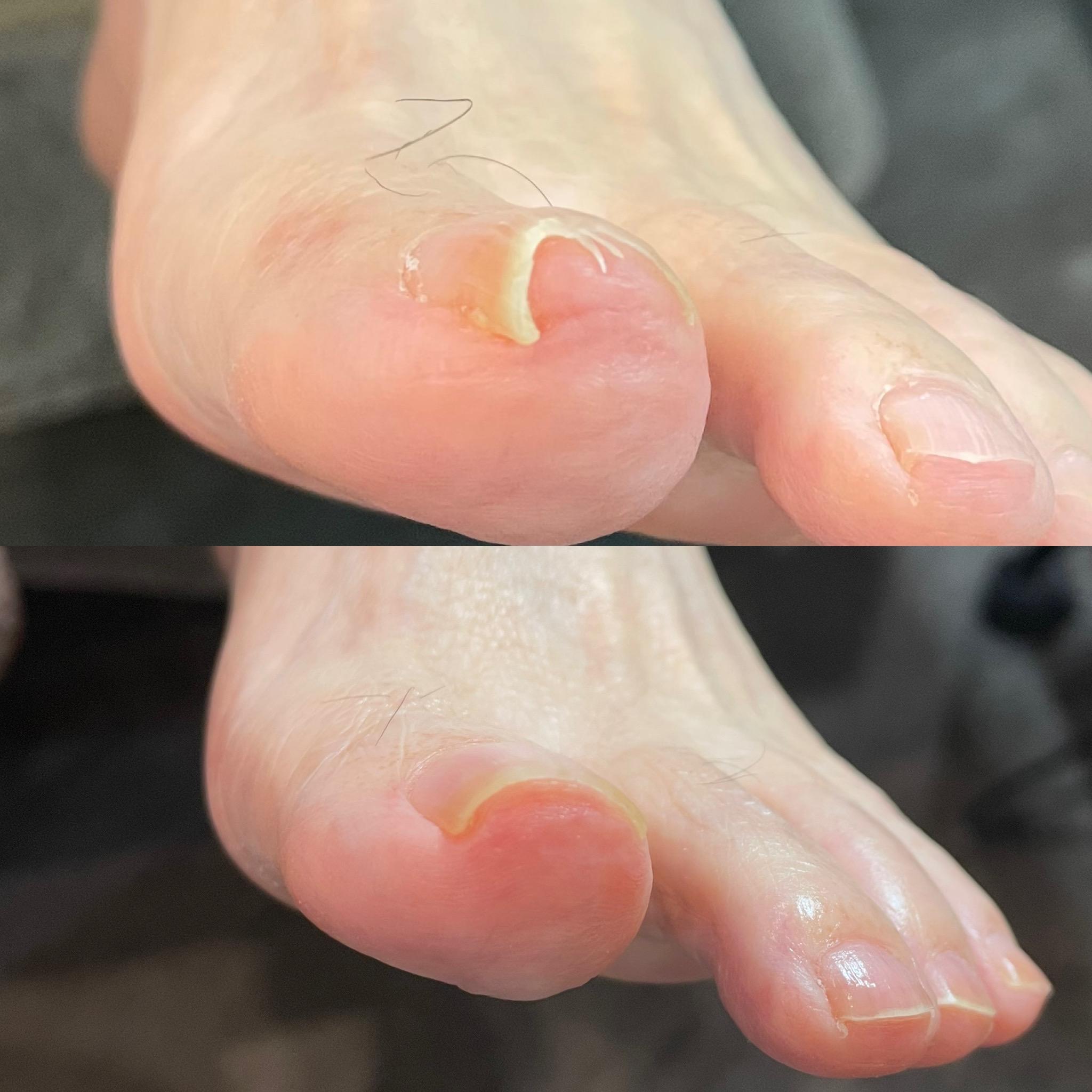 巻き爪の症例写真