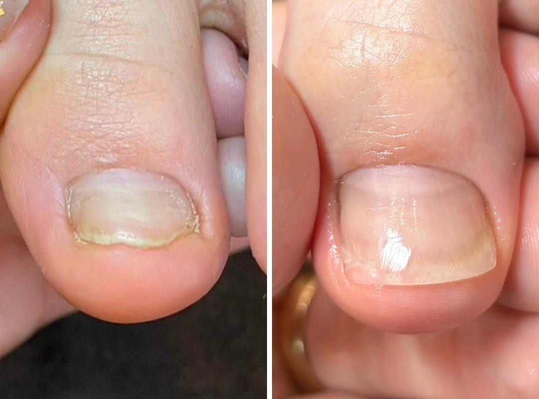 陥入爪・爪が伸びない方の症例写真