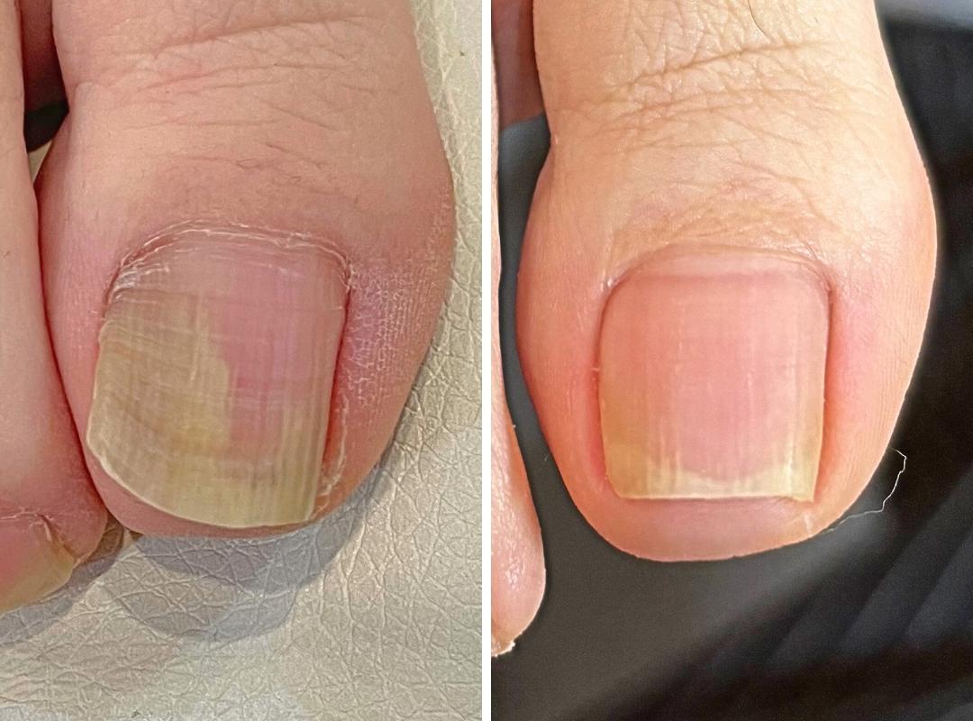 新浦安駅徒歩6分_手足のトラブル専門サロンaccorto_剥離の症例