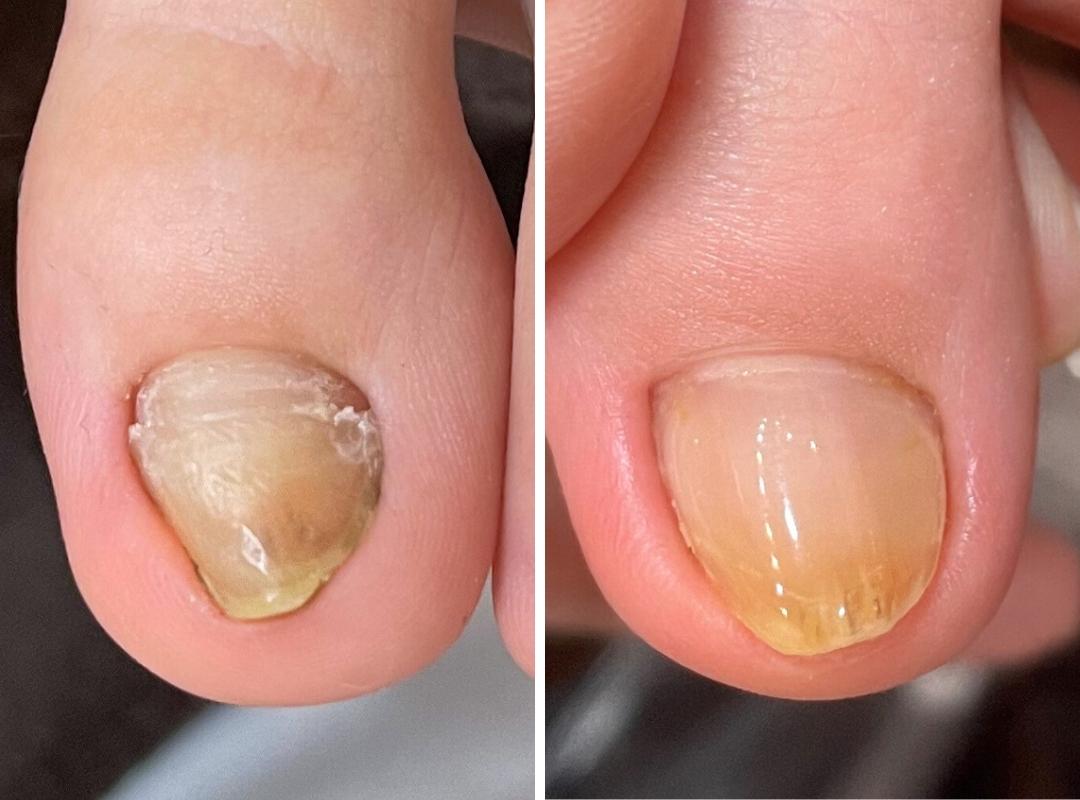 新浦安駅徒歩6分_手足のトラブル専門サロンaccorto_変形爪の症例