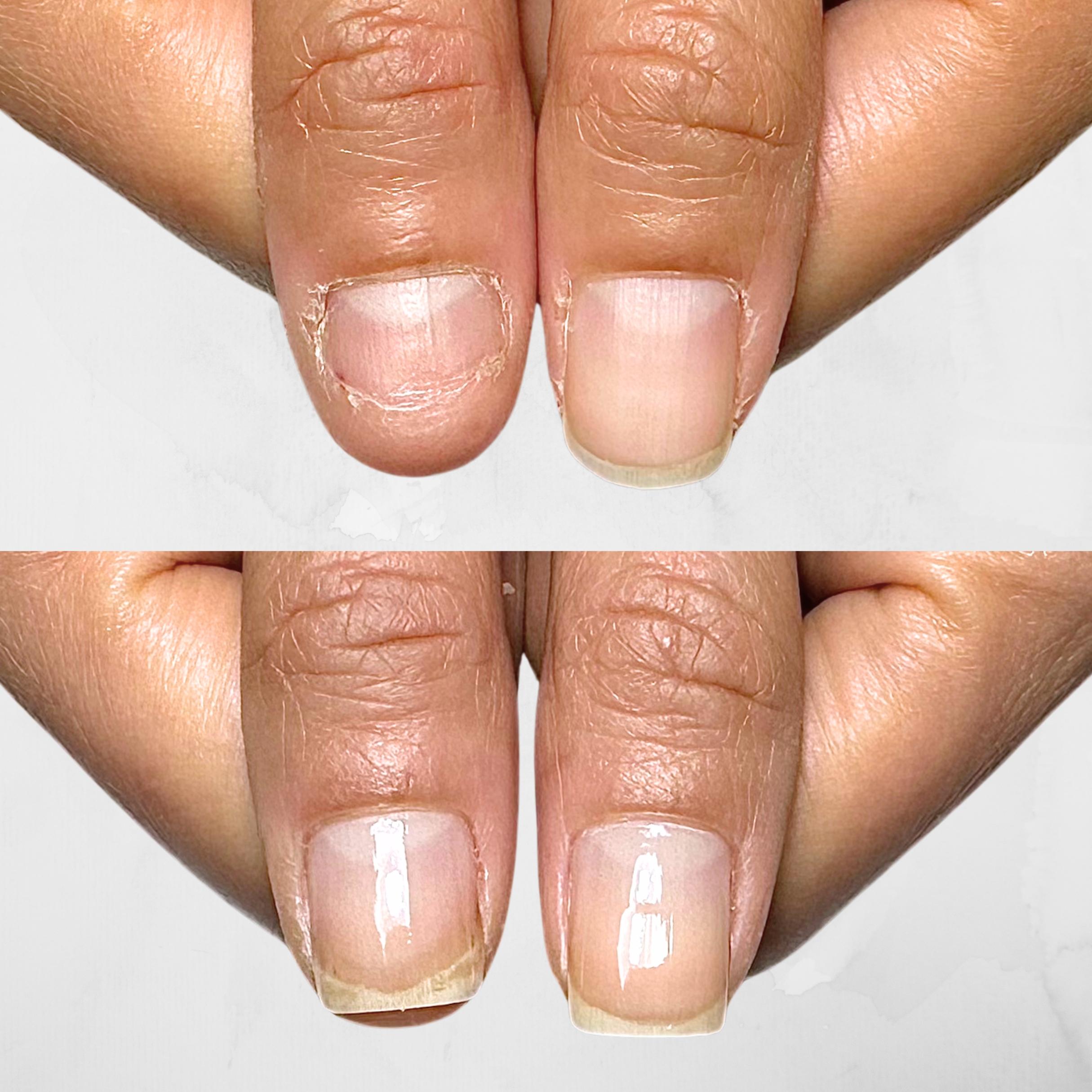 噛み癖 、むしり癖、深 爪 の症例写真　浜松市 | 自爪育成ネイルケアサロン Nail salon Nagi
