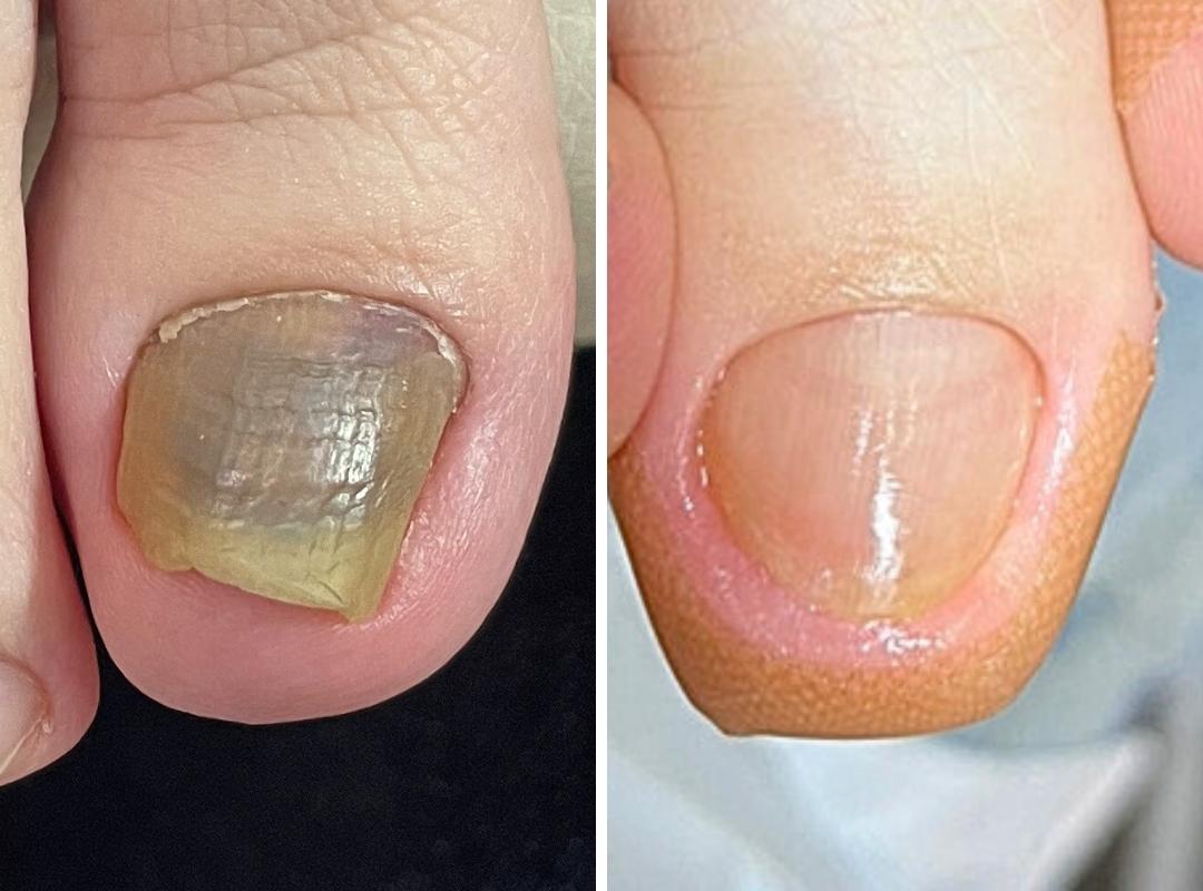 変形爪・肥厚・段差・剥離の症例写真