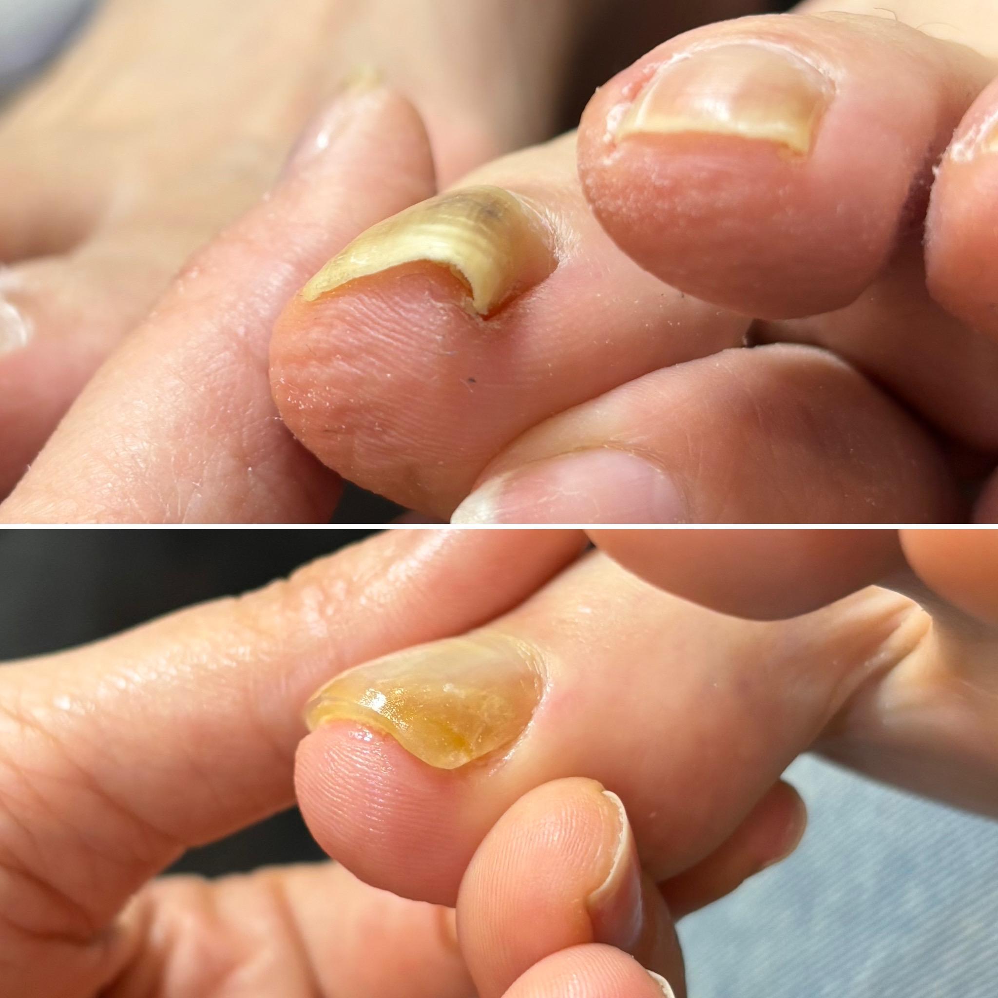 変形爪・巻き爪の症例写真