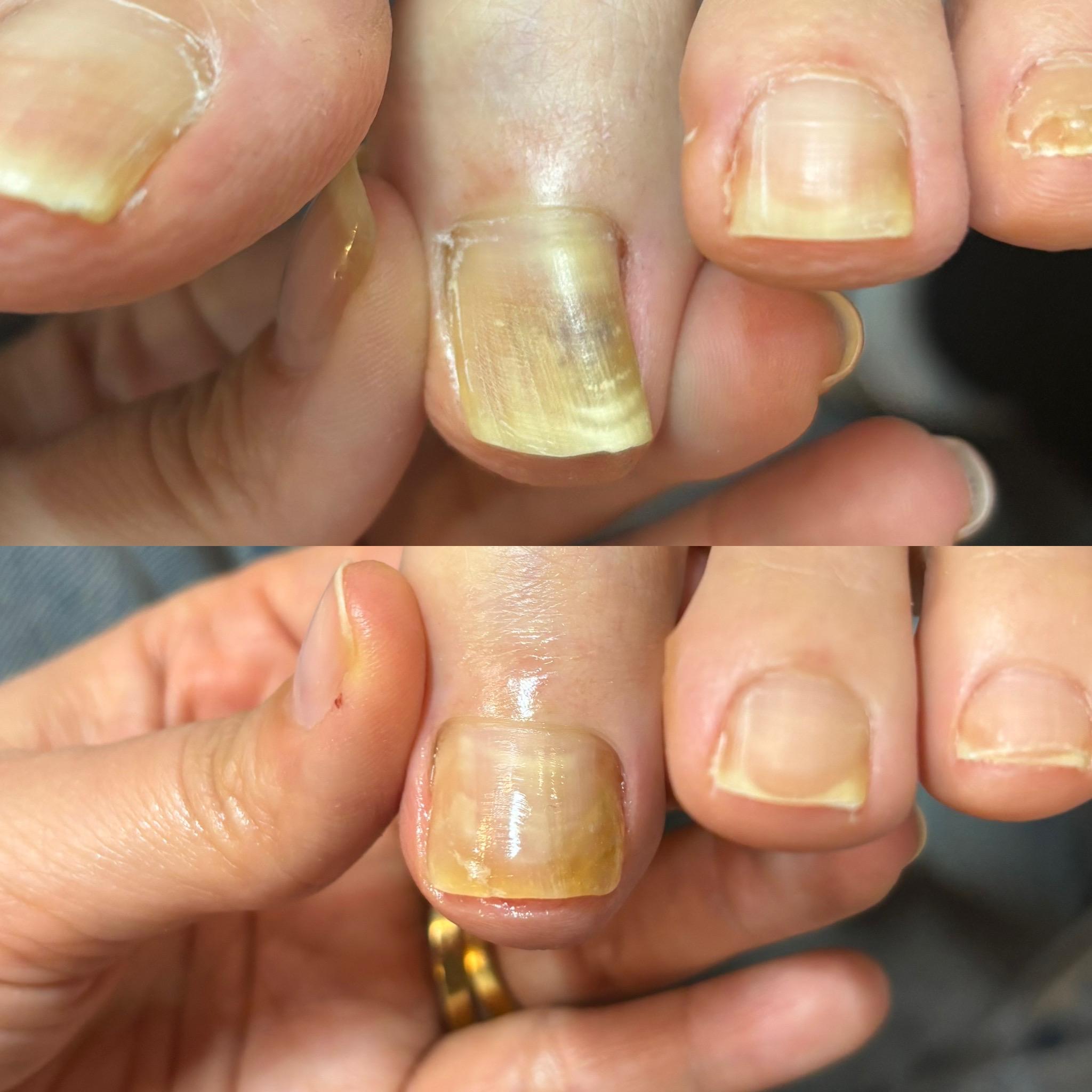 変形爪・巻き爪の症例写真