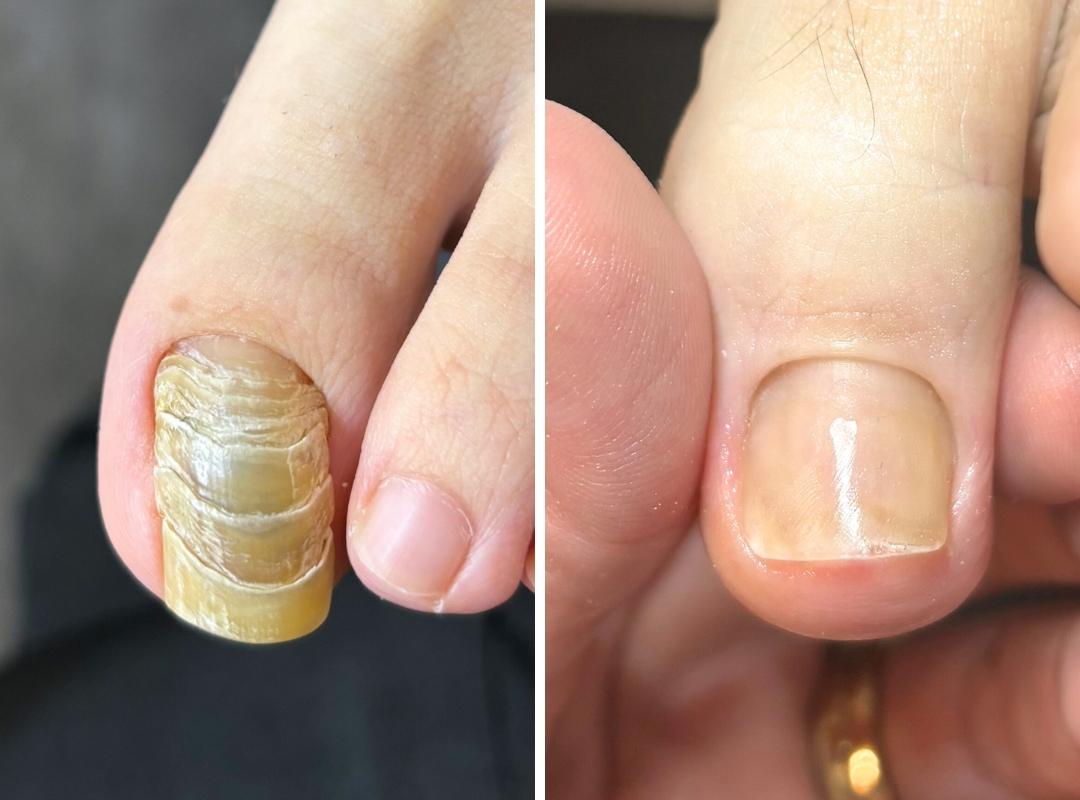 新浦安の巻き爪・変形爪矯正｜浦安の足爪トラブル専門サロンaccortoの爪甲湾症の症例の写真