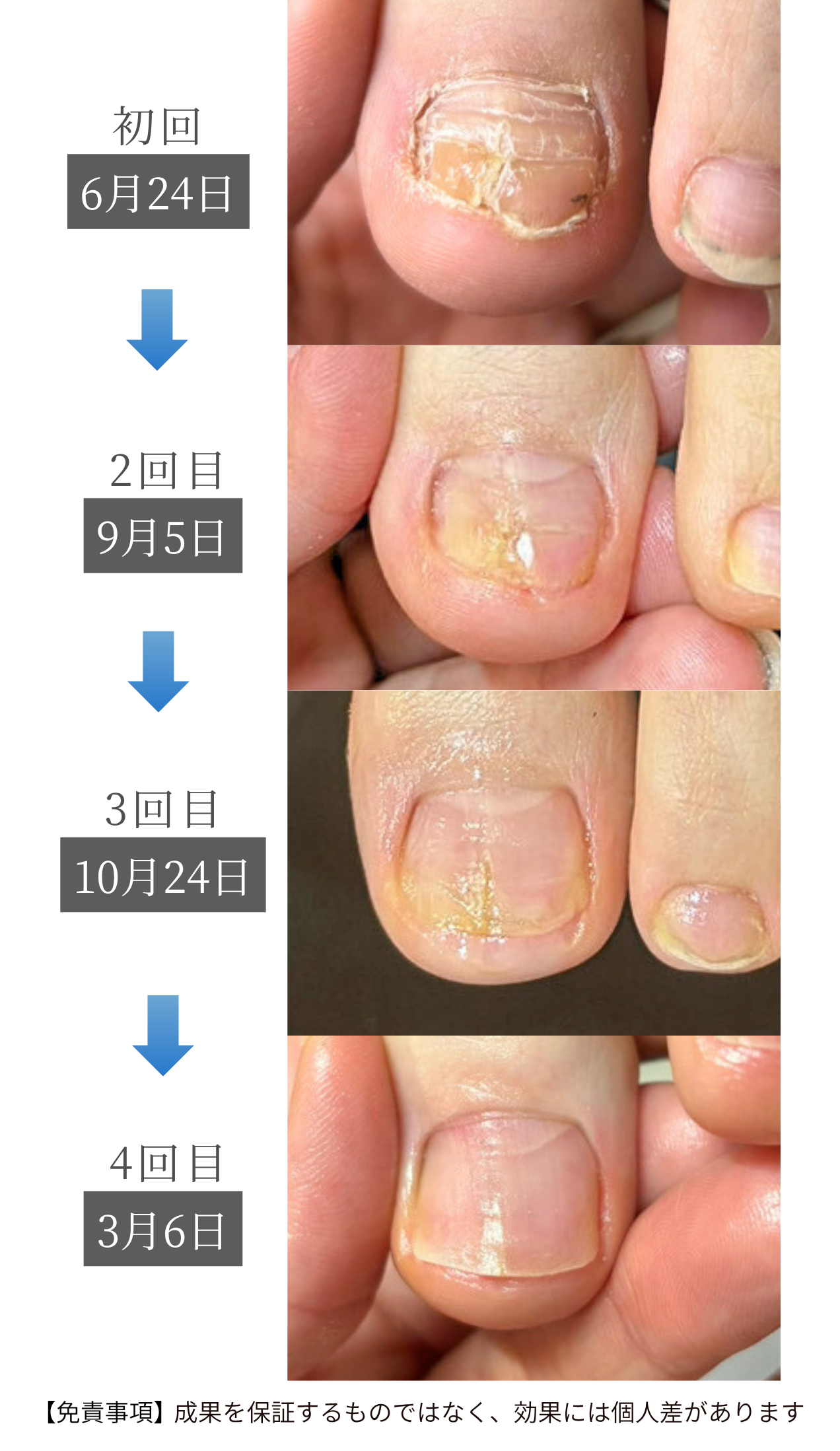 新浦安駅徒歩6分_手足のトラブル専門サロンaccorto_変形爪の育成過程