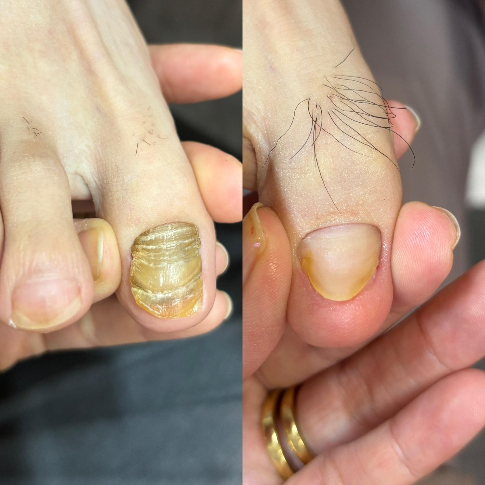 爪甲湾症の症例写真