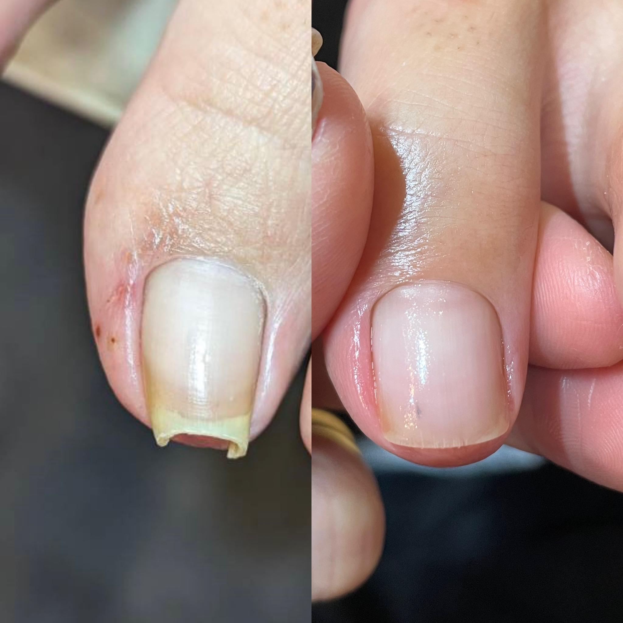 巻き爪の症例写真