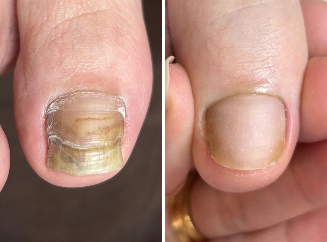 変形爪・肥厚爪の症例写真
