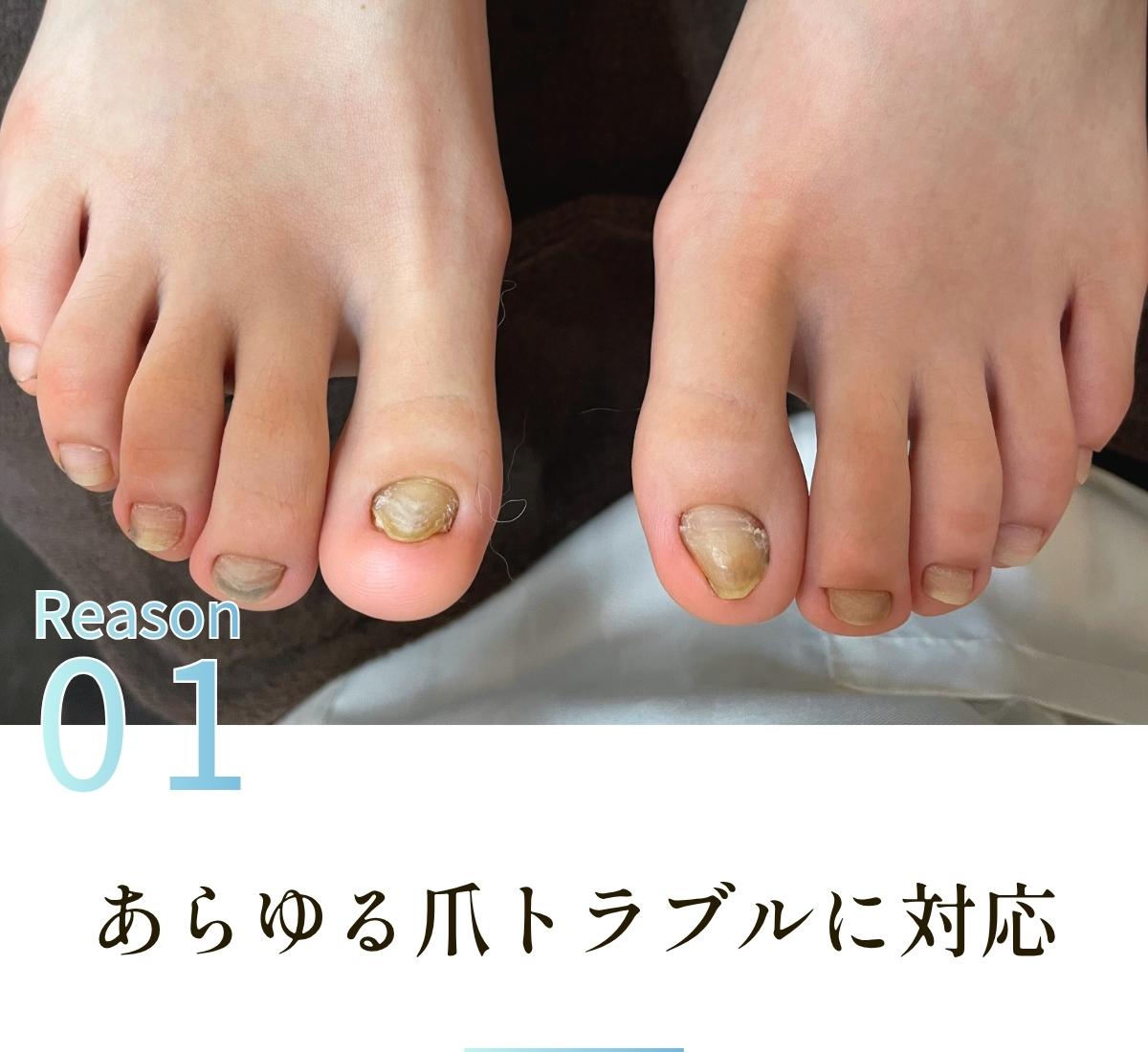 1＿あらゆる爪のトラブルに対応