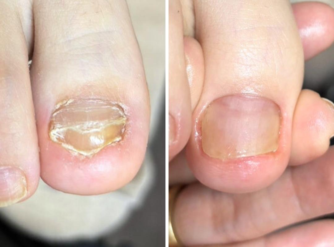 変形爪・段差の症例写真