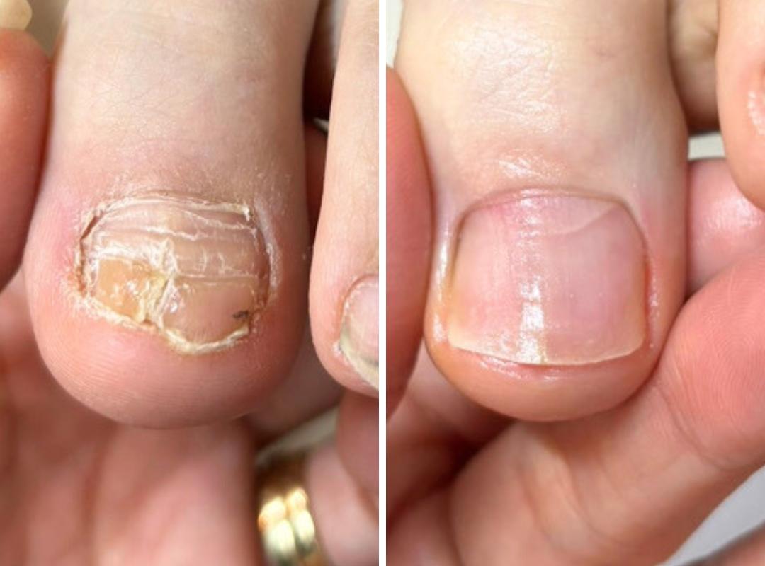 新浦安駅徒歩6分_手足のトラブル専門サロンaccorto_変形爪の症例