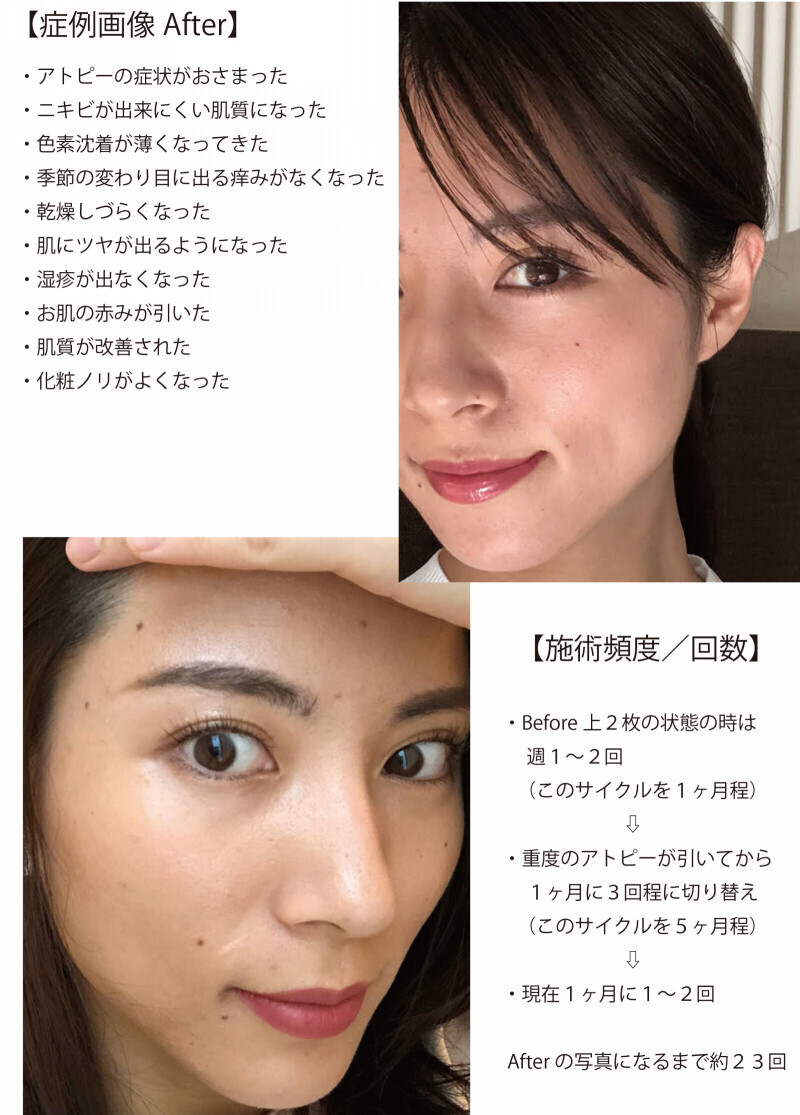 プラズマ　 エステ 最先端プラズマシャワーPLASMA REVO.V（プラズマレボV)｜有限