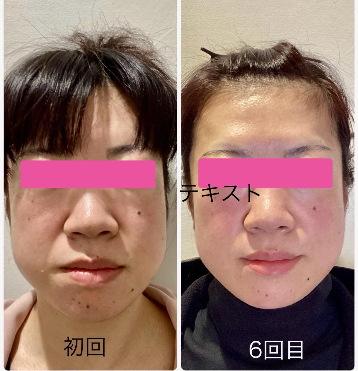 素肌再生術のビフォア・アフター 頬